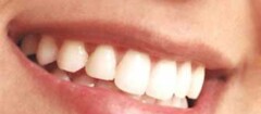 implantes-dentarios-em-suzano-1436558010