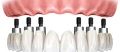 proteses-em-suzano-1436563432